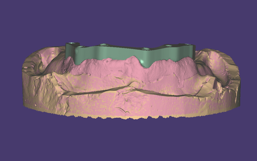 Visualizzazione digitale di una barra protesica implantare, progettata per precisione e stabilità.