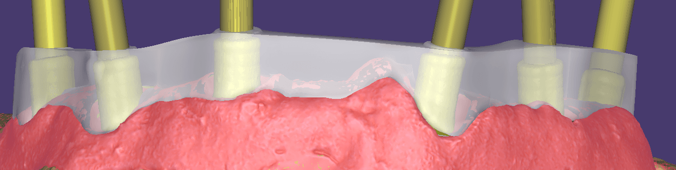 Design digitale di una struttura protesica su impianti per un'accurata pianificazione del sorriso.