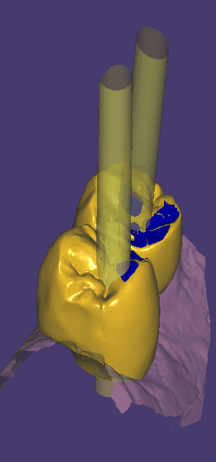 Visualizzazione CAD/CAM della fresatura di corone, evidenziando la precisione del processo digitale.